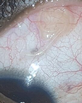 NEOflorax helps eliminate worms in the eyes