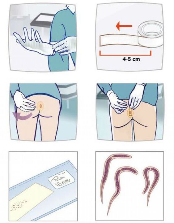 Take a stool sample to test for parasites