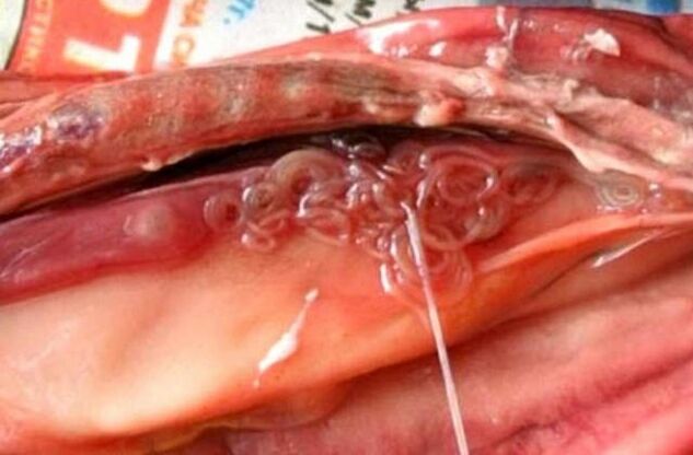 flukes in the gallbladder